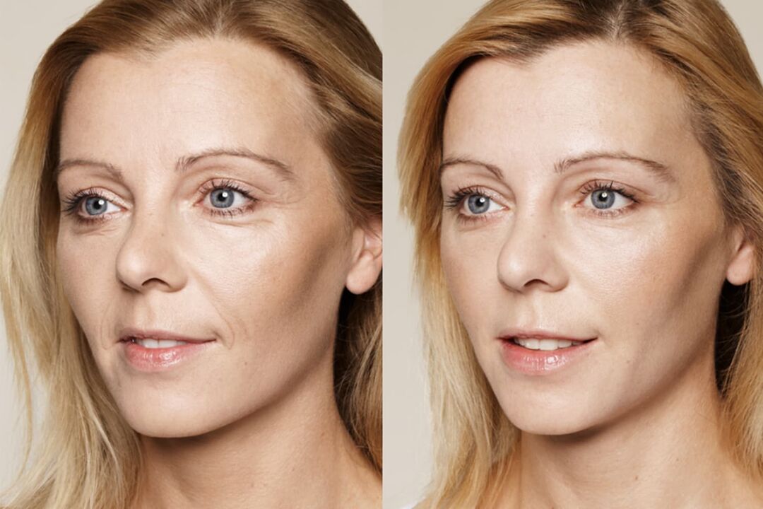 Benutzererfahrung vor und nach der Anwendung der intenskin-Creme von Valeria